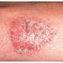 Kožní onemocnění +2